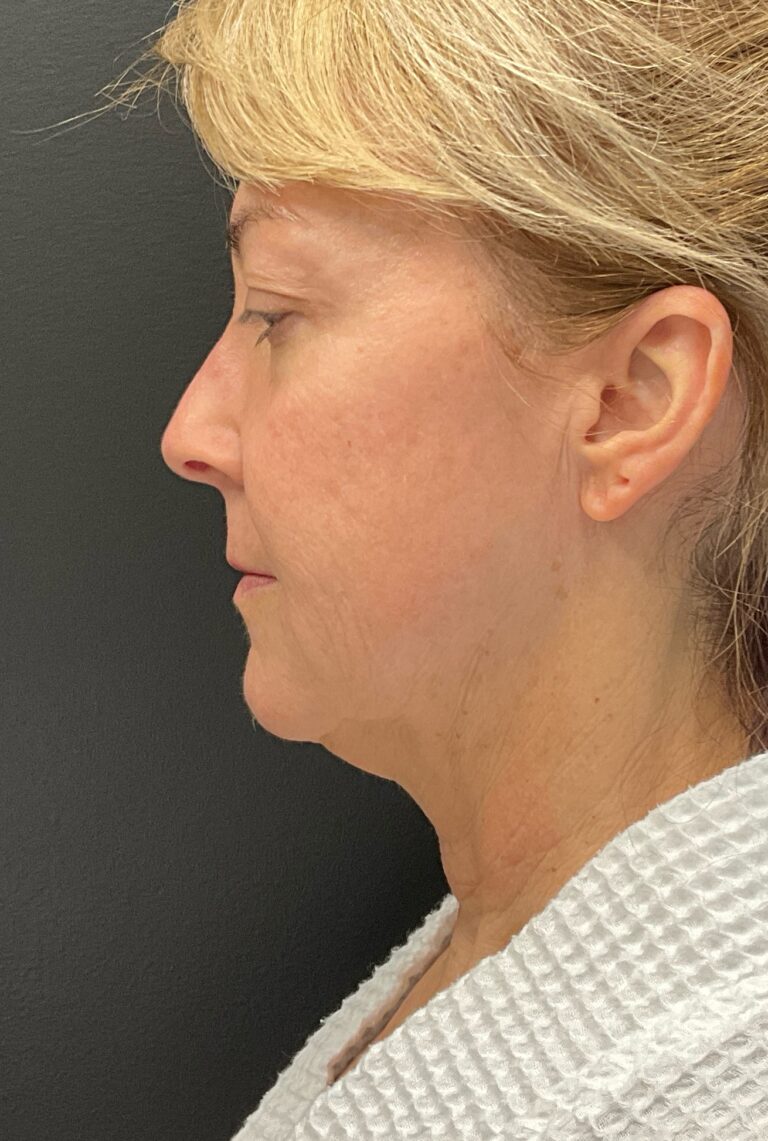 Before Image: Morpheus8 – Face and Neck - left-side