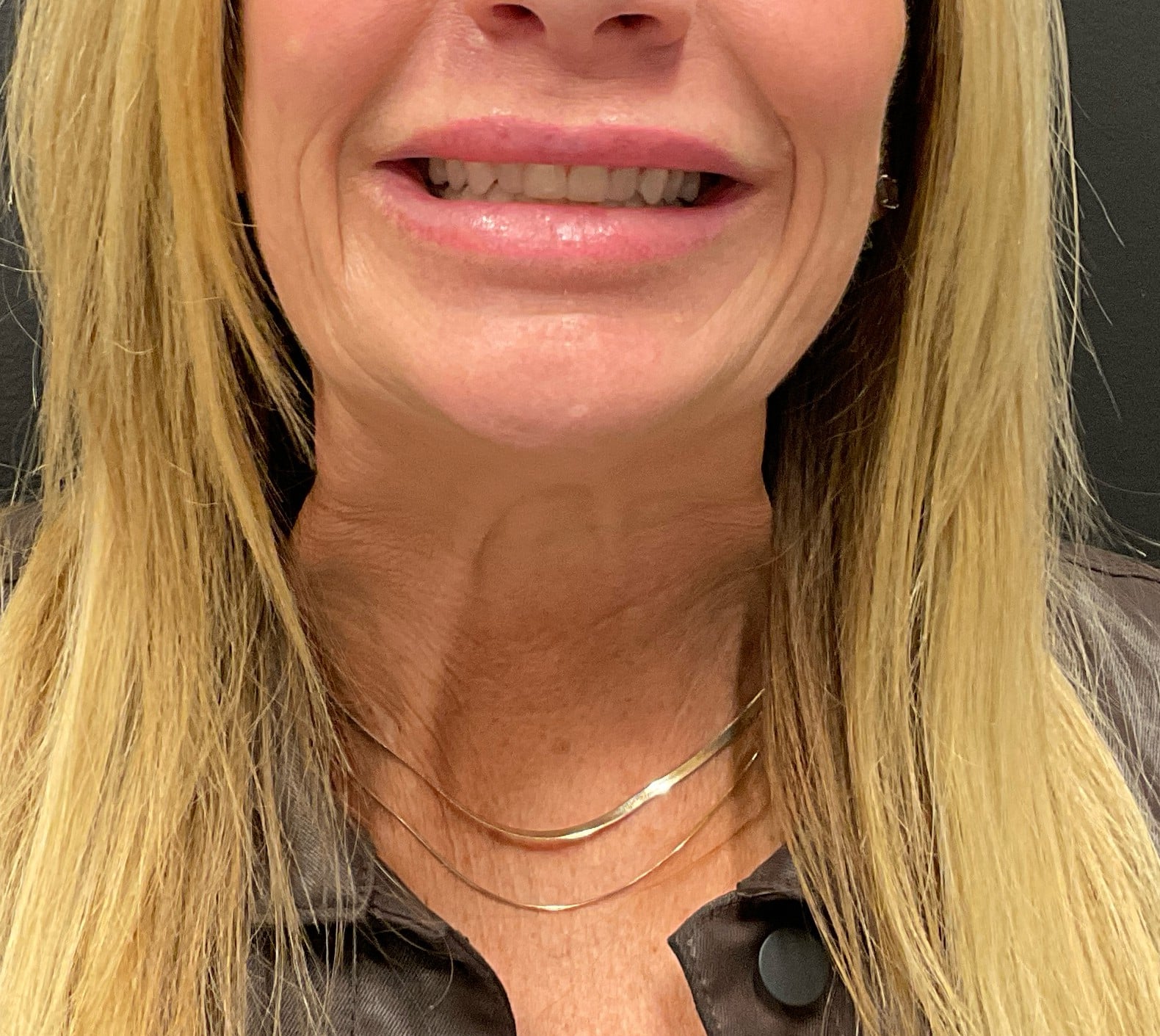 Before Image: Botox – Platysmal Bands (neck) - front
