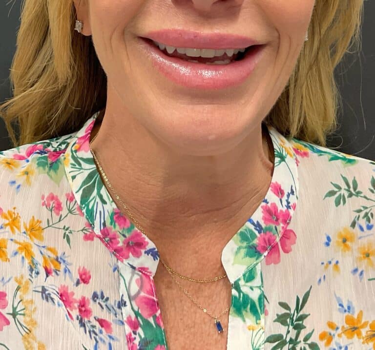 After Image: Botox – Platysmal Bands (neck) - front