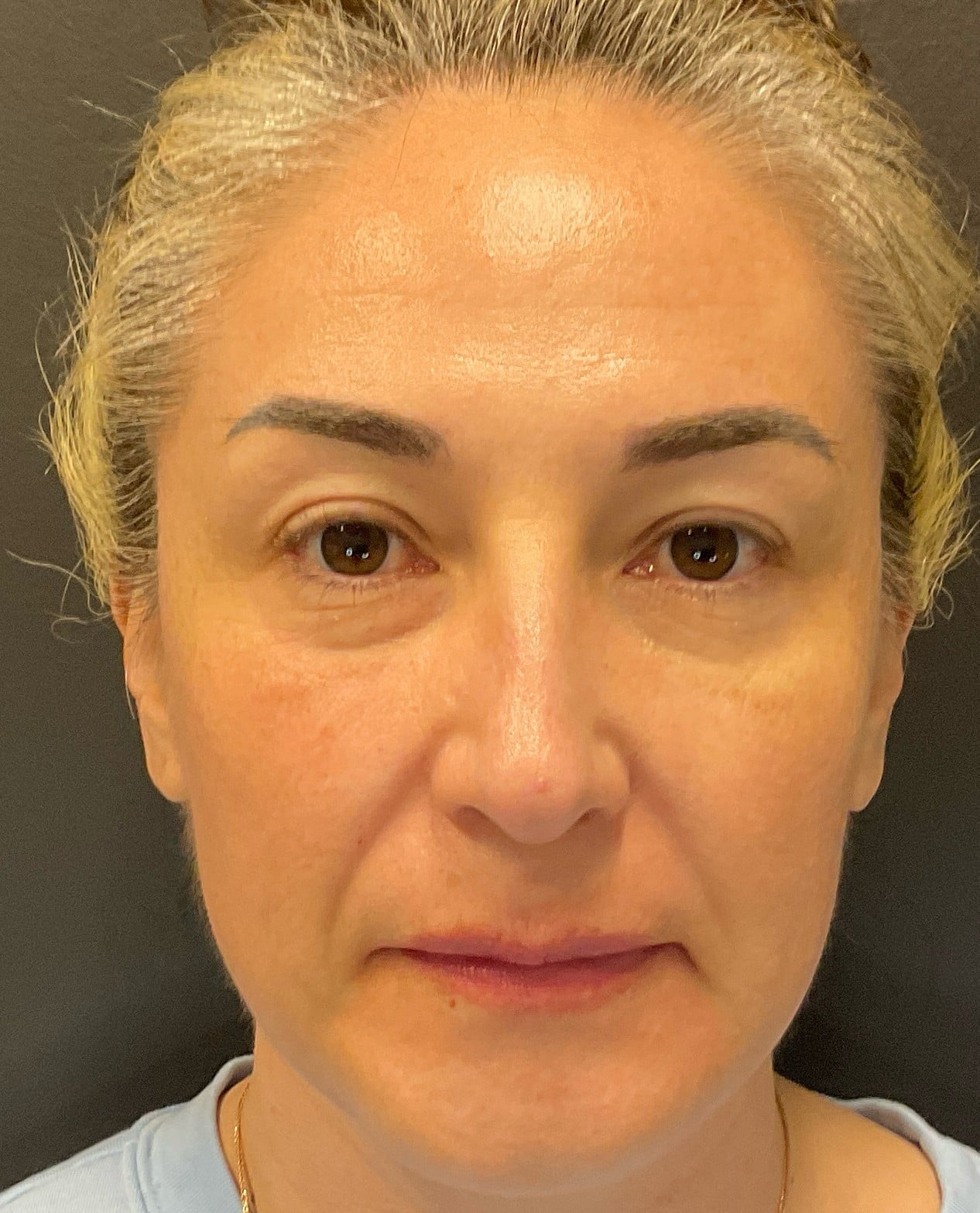 Before Image: Radiesse – Cheeks - front
