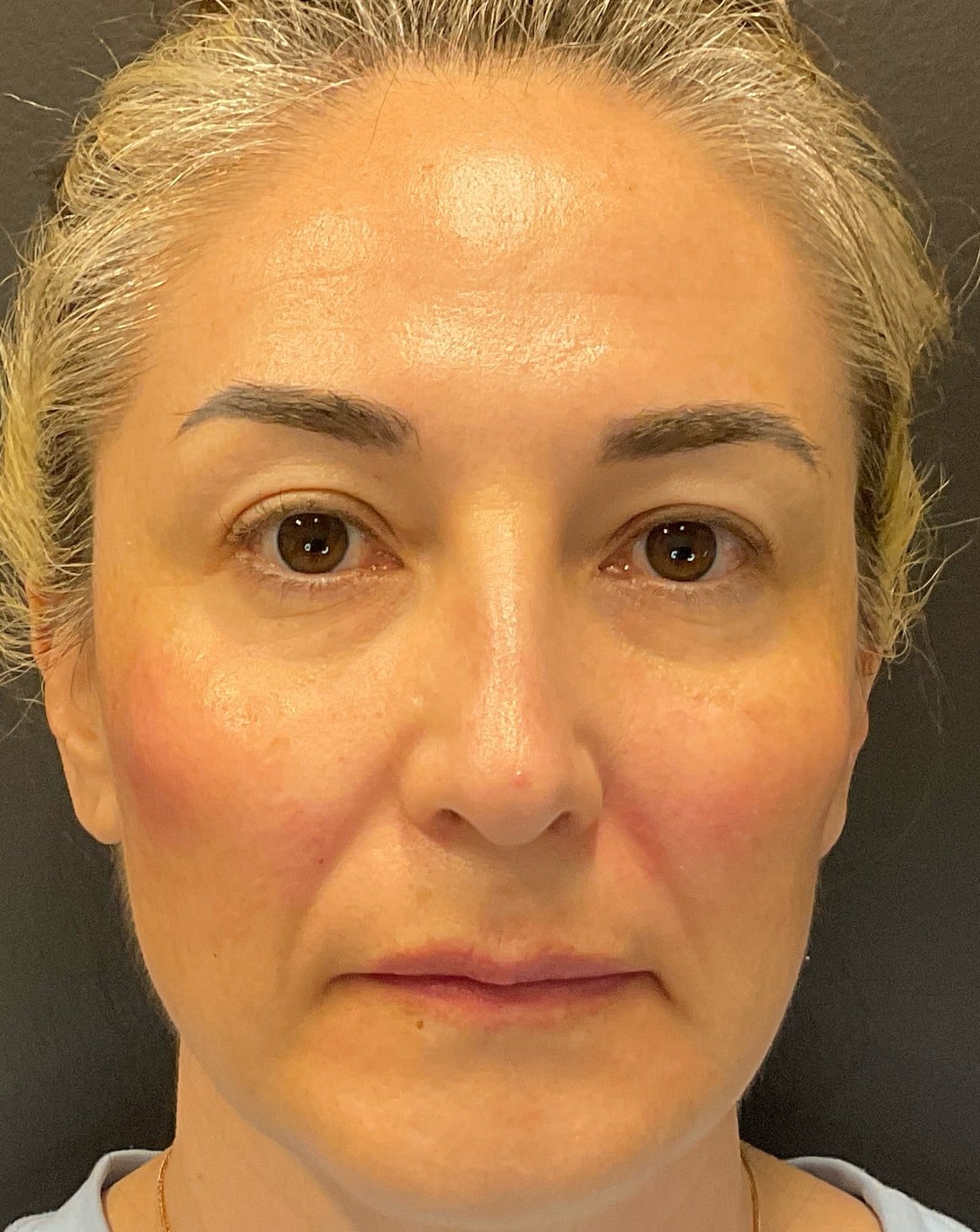 After Image: Radiesse – Cheeks - front