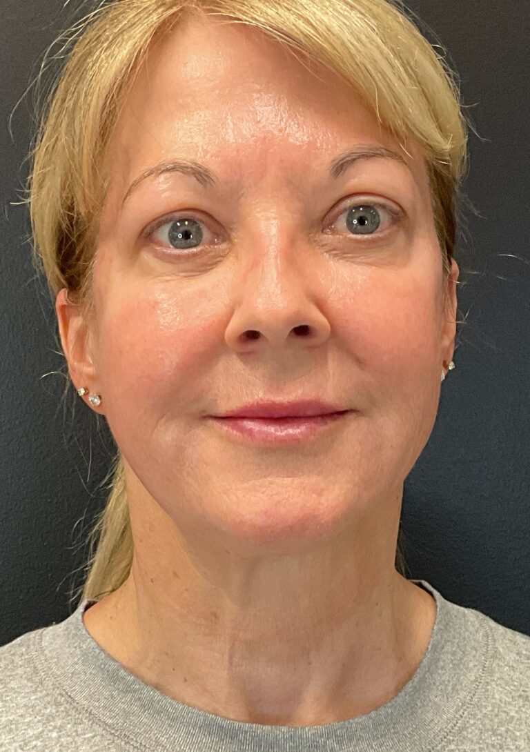 After Image: Morpheus8 – Face and Neck - front
