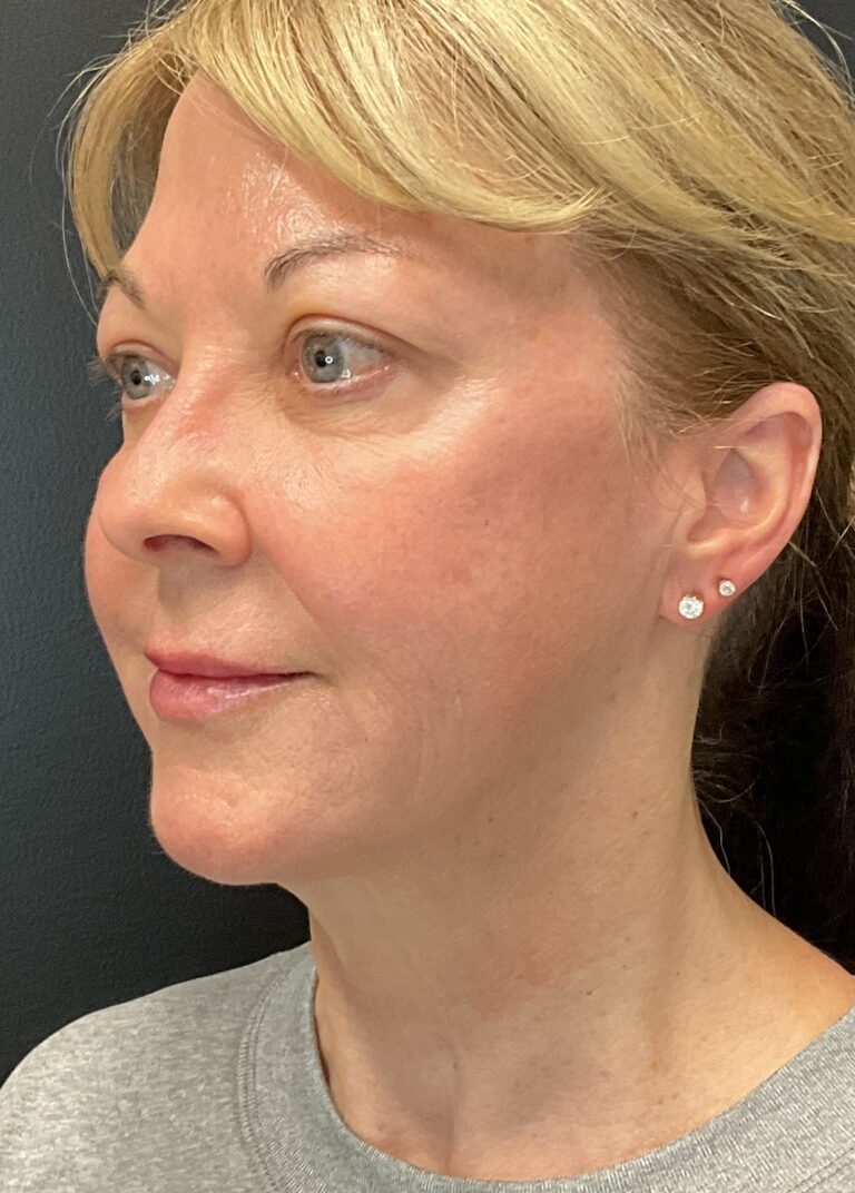 After Image: Morpheus8 – Face and Neck - left-front-oblique