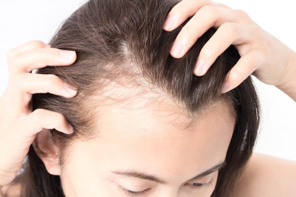 Woman showing thinning hair at hair line