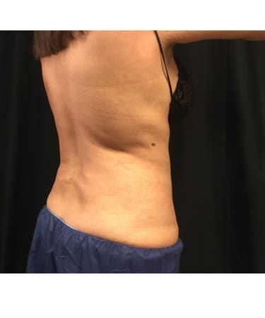 After Image: CoolSculpting – Upper Flanks - front