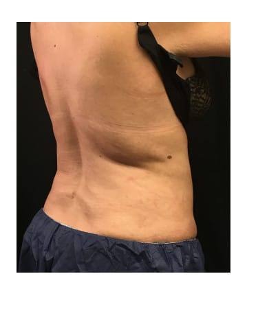 Before Image: CoolSculpting – Upper Flanks - front