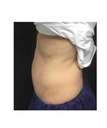 After Image: CoolSculpting – Abdomen - other