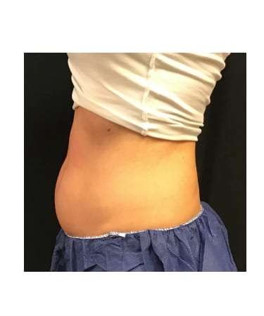 Before Image: CoolSculpting – Abdomen - other
