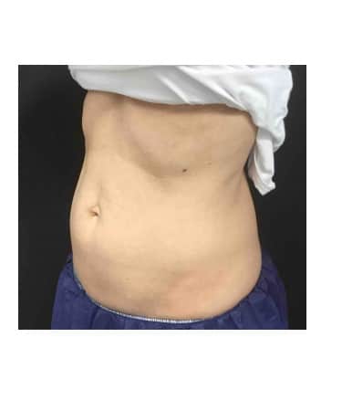 After Image: CoolSculpting – Abdomen - left-front-oblique