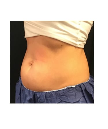 Before Image: CoolSculpting – Abdomen - left-front-oblique