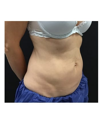 After Image: CoolSculpting – Abdomen - right-front-oblique