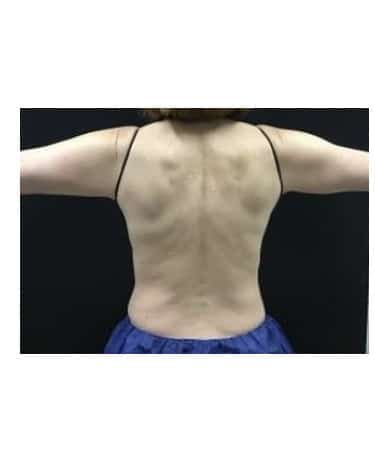 After Image: CoolSculpting – Upper Flank, Lower Flank, and Bra Strap area - front