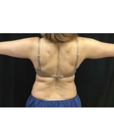 Before Image: CoolSculpting – Upper Flank, Lower Flank, and Bra Strap area - front