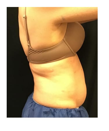 Before Image: CoolSculpting – Upper Flank, Lower Flank, and Bra Strap area - other