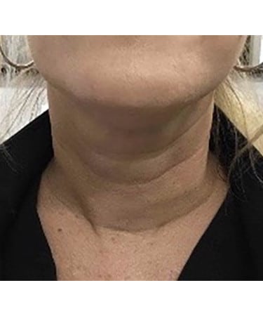 After Image: Dermal Filler – Hyperdilute Radiesse (neck)