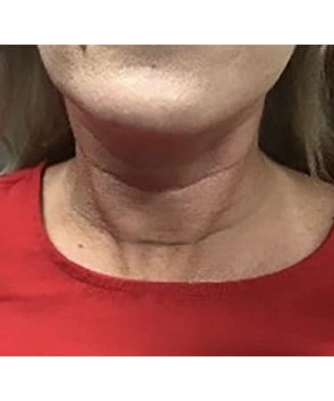 Before Image: Dermal Filler – Hyperdilute Radiesse (neck)