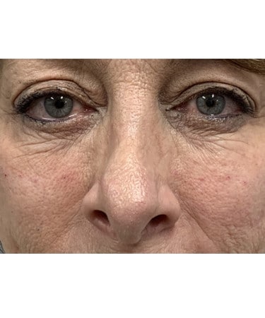 After Image: Dermal Filler – Belotero (tear troughs) - front