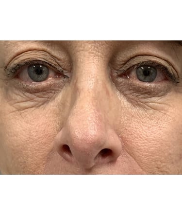 Before Image: Dermal Filler – Belotero (tear troughs) - front