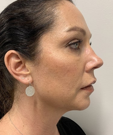 After Image: Dermal Filler – Radiesse (chin)