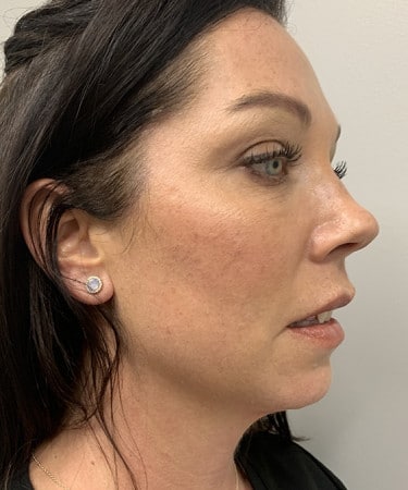 Before Image: Dermal Filler – Radiesse (chin)