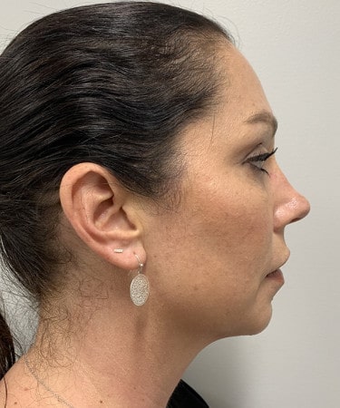 After Image: Dermal Filler – Radiesse (chin) - other