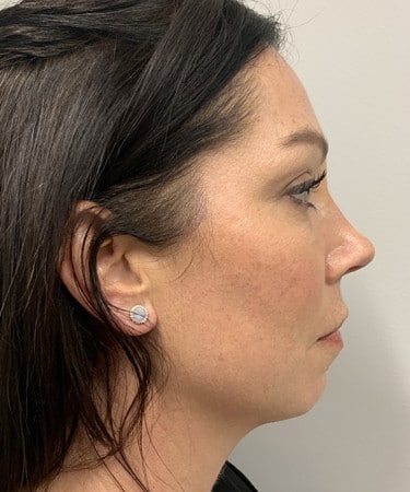 Before Image: Dermal Filler – Radiesse (chin) - other