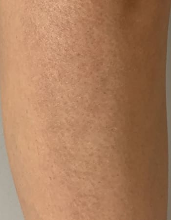 After Image: Microneedling – Scar on Leg - other