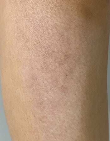 Before Image: Microneedling – Scar on Leg - other