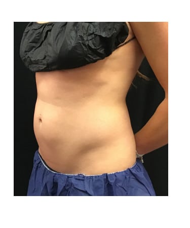 After Image: CoolSculpting – Upper & Lower Abdomen - left-front-oblique