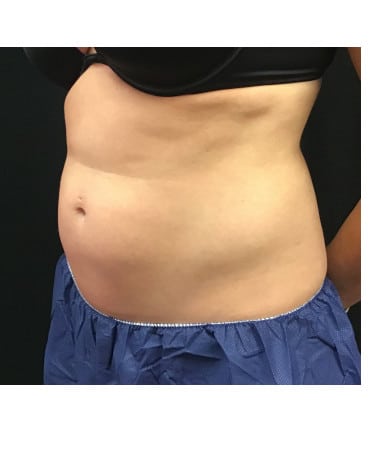 Before Image: CoolSculpting – Upper & Lower Abdomen - left-front-oblique