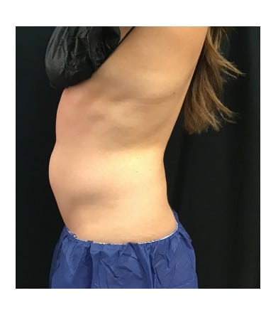 After Image: CoolSculpting – Upper & Lower Abdomen - other