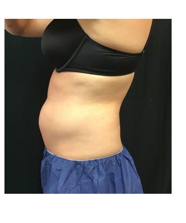 Before Image: CoolSculpting – Upper & Lower Abdomen - other