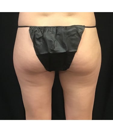 After Image: CoolSculpting – Inner Thighs - back