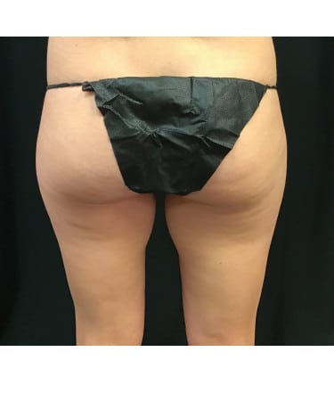 Before Image: CoolSculpting – Inner Thighs - back