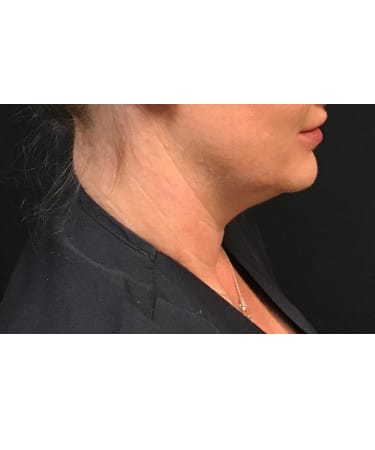 Before Image: CoolSculpting – Submental (under chin) - other