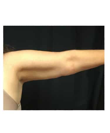 After Image: CoolSculpting – Arms - front