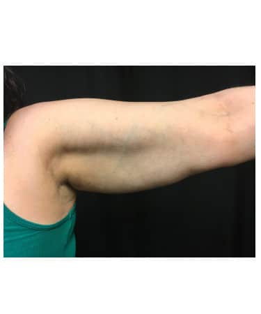 Before Image: CoolSculpting – Arms - front