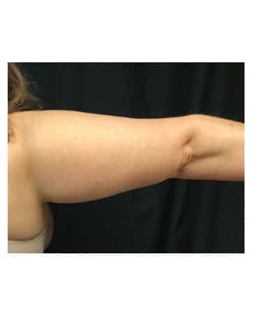 After Image: CoolSculpting – Arms - back