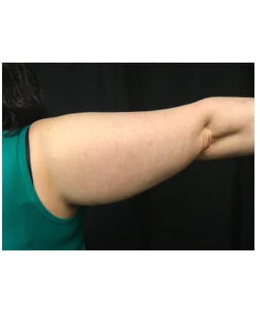 Before Image: CoolSculpting – Arms - back
