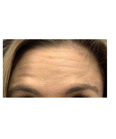 After Image: Xeomin – Forehead, Glabella, Crows Feet - front