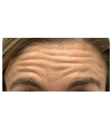 Before Image: Xeomin – Forehead, Glabella, Crows Feet - front
