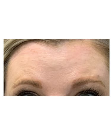 After Image: Xeomin – Forehead, Glabella, and Crows Feet - front