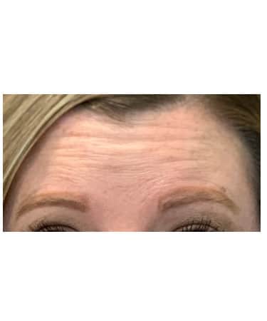 Before Image: Xeomin – Forehead, Glabella, and Crows Feet - front