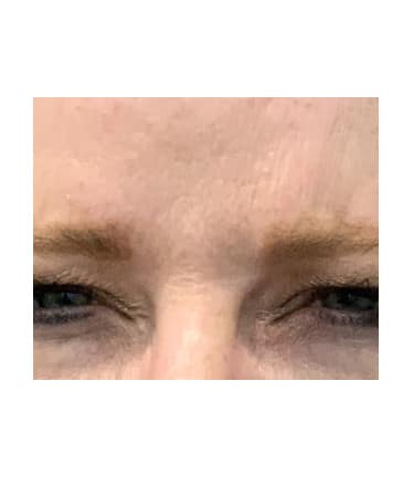 After Image: Xeomin – Forehead, Glabella, and Crows Feet - front