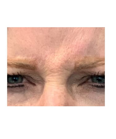 Before Image: Xeomin – Forehead, Glabella, and Crows Feet - front