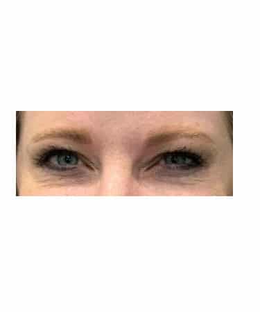 After Image: Xeomin – Forehead, Glabella, and Crows Feet - front