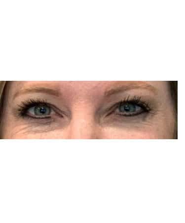 Before Image: Xeomin – Forehead, Glabella, and Crows Feet - front
