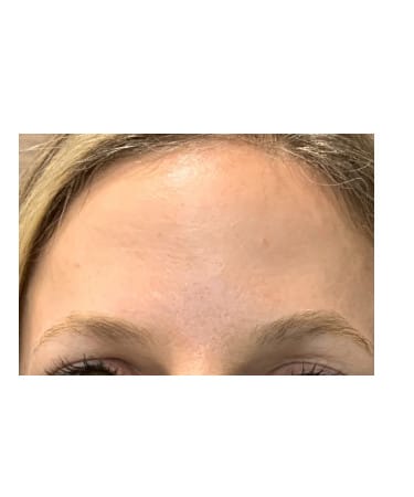 After Image: Xeomin – Forehead, Glabella, and Crows Feet