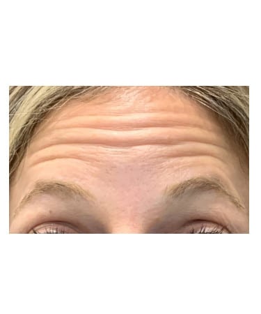 Before Image: Xeomin – Forehead, Glabella, and Crows Feet
