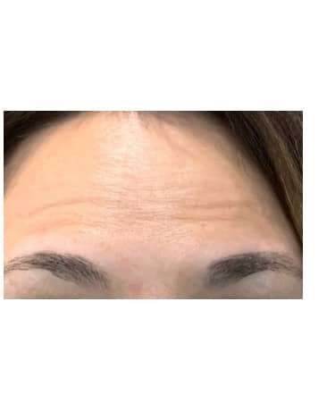 After Image: Botox – Forehead and Glabella